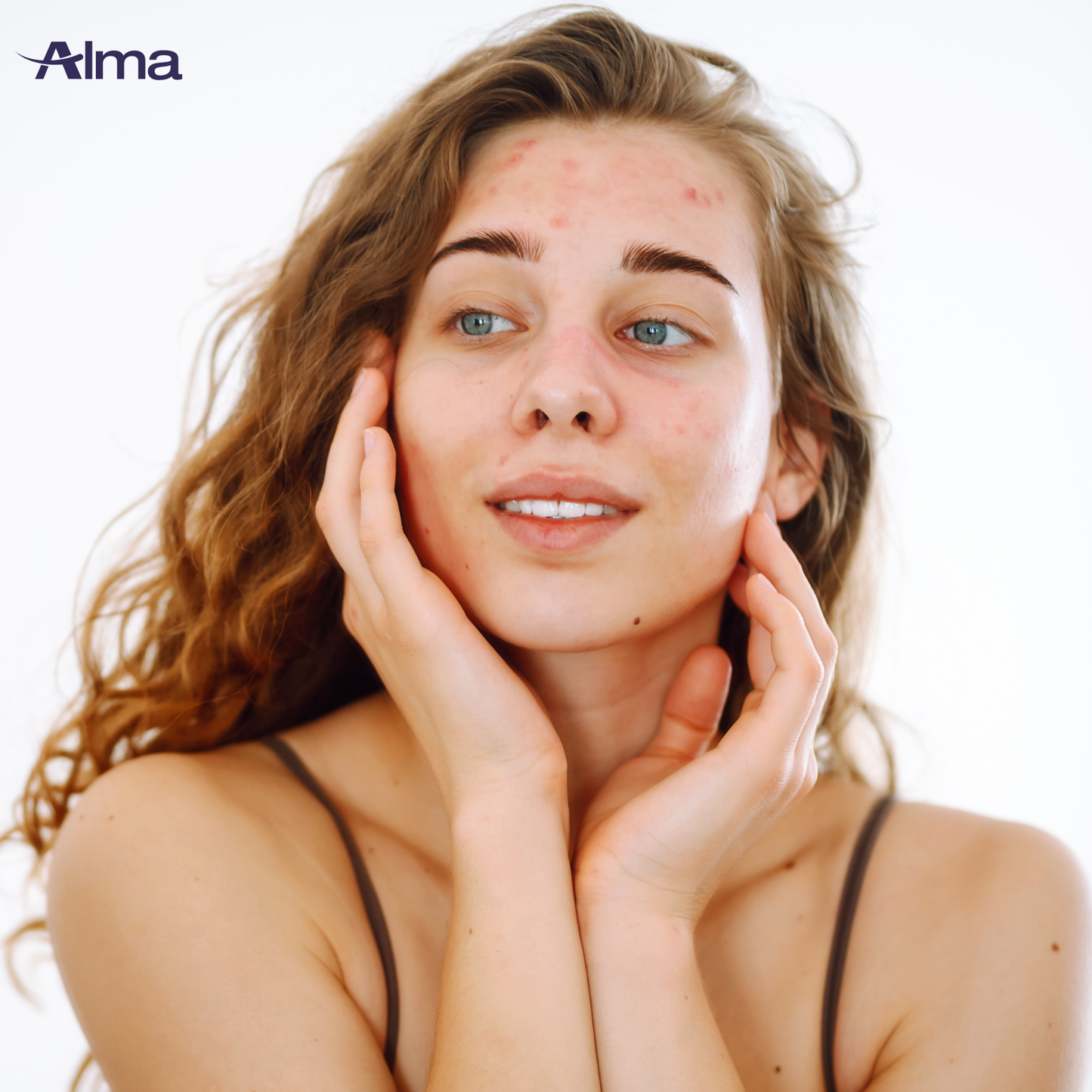 CO2 Acne + Pigment Treatment
