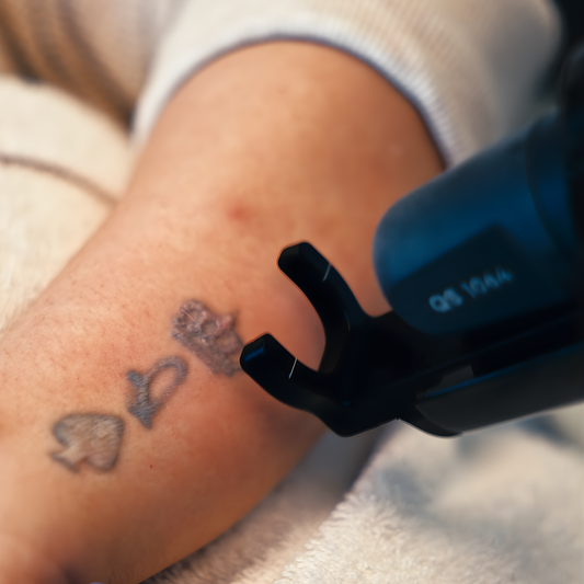 Tattoo Removal